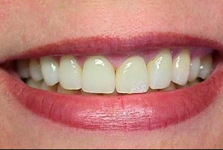 Фото после выравнивания зубов винирами