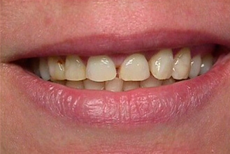 Фото до выравниваяни зубов винирами