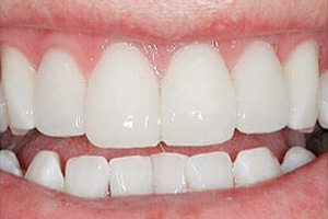 Фото после установки виниров на зубы