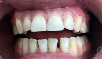 Щель между передними зубами закрыта