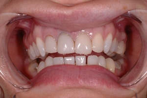 Фото до выравниваяни зубов винирами нижний ряд