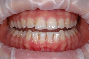 Зубной камень между зубами фото