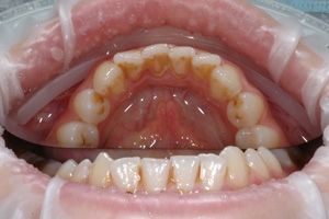 Зубной камень с внутренней стороны зубов