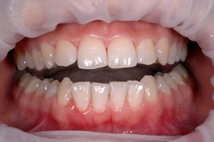 Фото после чистки зубов от зубного камня